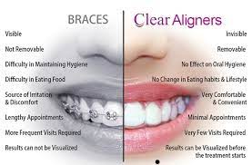 aligner